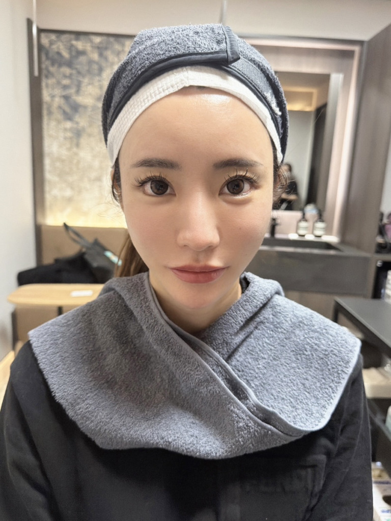 橘ななさんのヒアルロン酸ビフォー写真