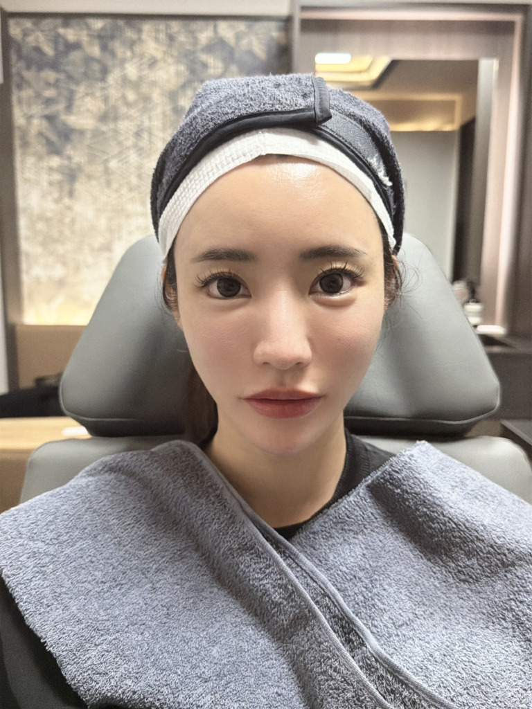 橘ななさんのヒアルロン酸ビアフター写真