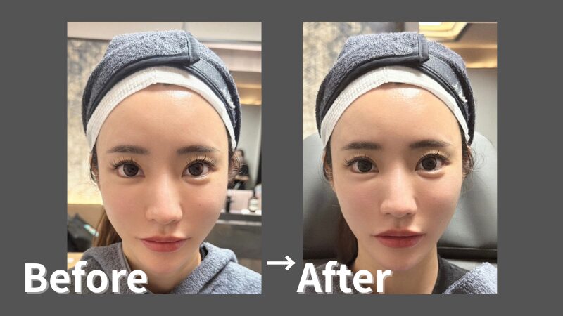 橘ななさんのヒアルロン酸ビフォーアフター