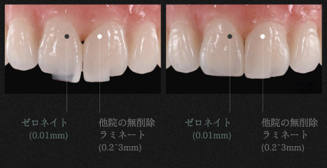 TU歯科のゼロネイトと従来のラミネートの違い
