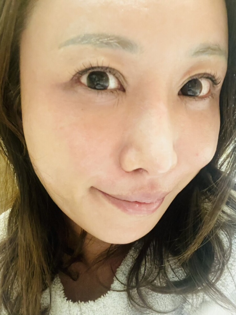 肌管理をして一週間後のなつみさんの肌状態