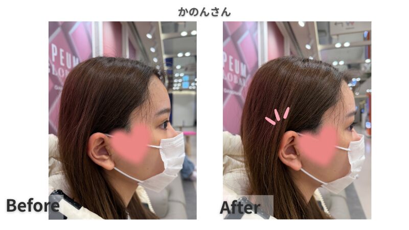 プムグローバルクリニック江南店で立ち耳フィラーを受けたかのんさん