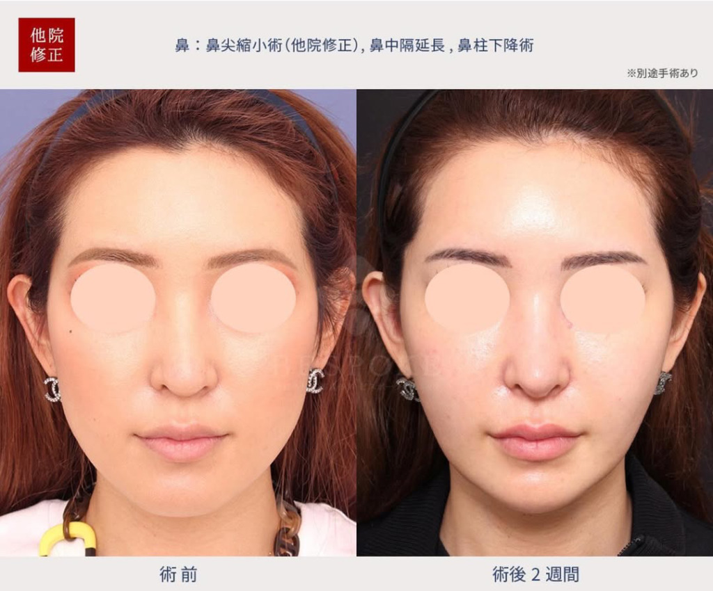 ビスポーククリニックの鼻整形を徹底解説｜症例・口コミ・料金まとめ｜キャバ嬢×美容メディア【Luxe Glow】美容医療・スキンケア・愛用コスメ紹介
