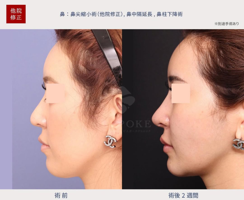 ビスポーククリニックの鼻整形を徹底解説｜症例・口コミ・料金まとめ｜キャバ嬢×美容メディア【Luxe Glow】美容医療・スキンケア・愛用コスメ紹介