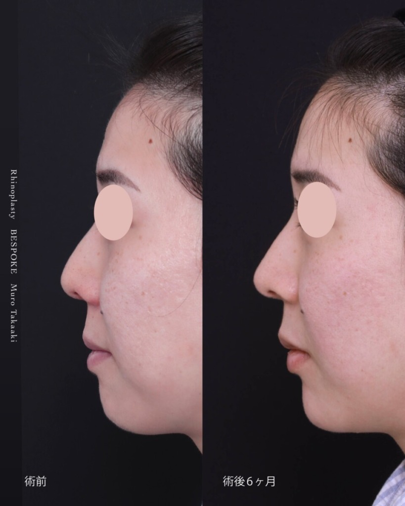 ビスポーククリニックの鼻整形