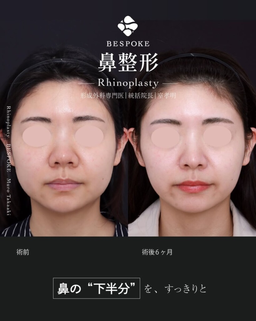 ビスポーククリニックの鼻整形を徹底解説