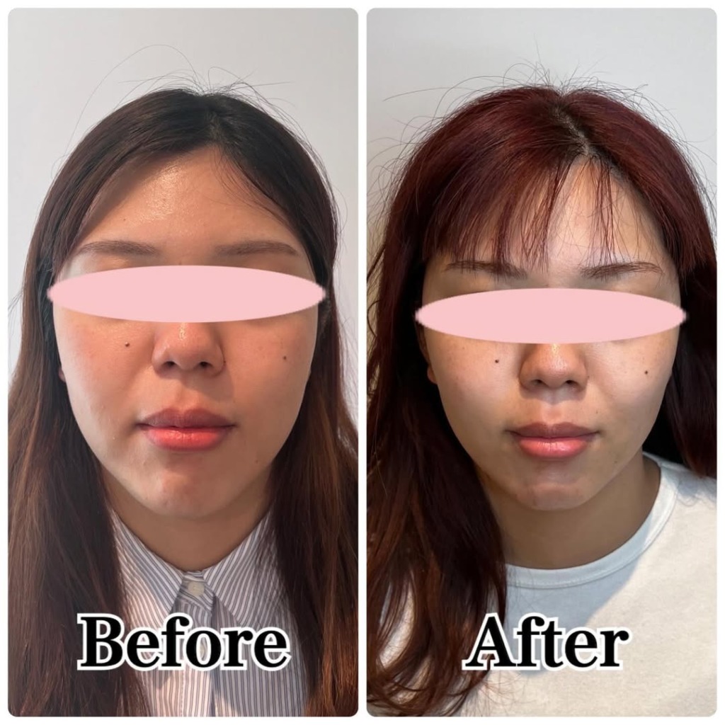 名古屋エステBIZINの整形に頼らない造顔をたちばなありすが体験