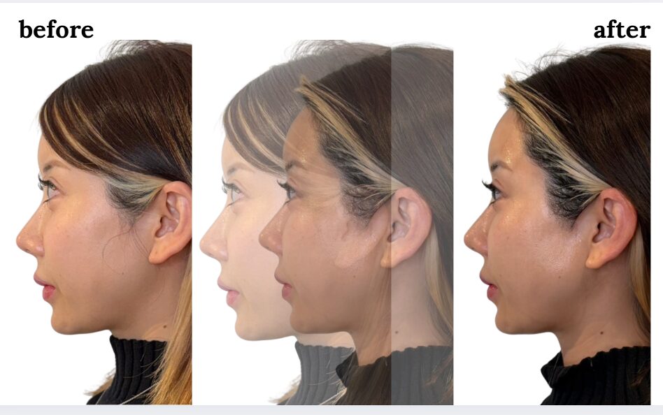 名古屋エステBIZINの整形に頼らない造顔をたちばなありすが体験