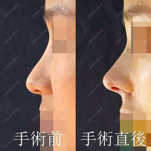 ゆいぴすが鼻整形した韓国・江南「コーヘン美容外科」|口コミや特徴を紹介|キャバ嬢×美容メディア【Luxe Glow】美容医療・スキンケア・愛用コスメ紹介