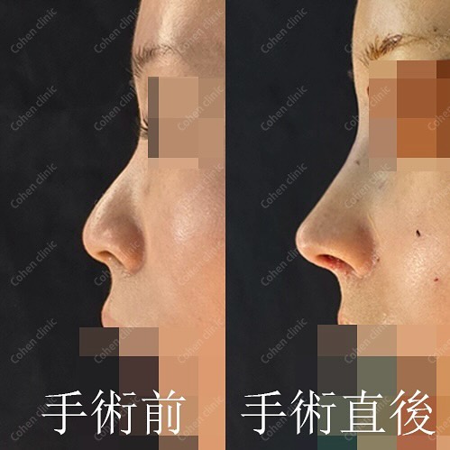 ゆいぴすが鼻整形した韓国・江南「コーヘン美容外科」|口コミや特徴を紹介|キャバ嬢×美容メディア【Luxe Glow】美容医療・スキンケア・愛用コスメ紹介