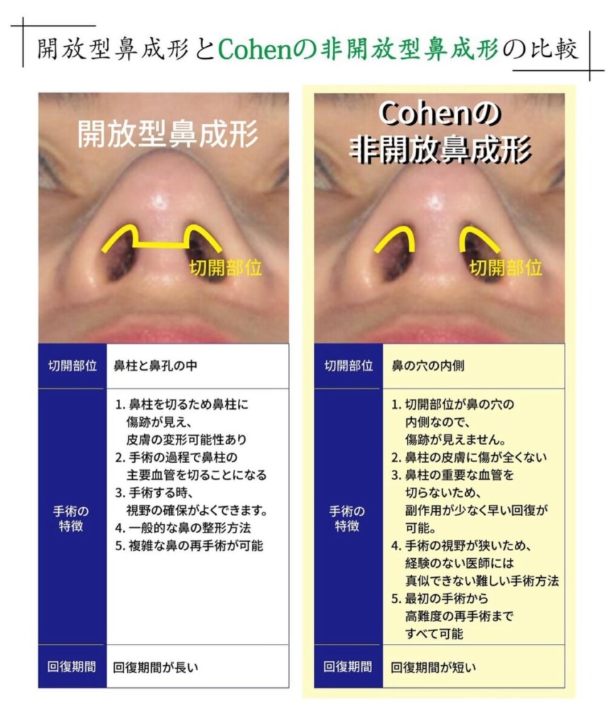 ゆいぴすが鼻整形した韓国・江南「コーヘン美容外科」|口コミや特徴を紹介|キャバ嬢×美容メディア【Luxe Glow】美容医療・スキンケア・愛用コスメ紹介