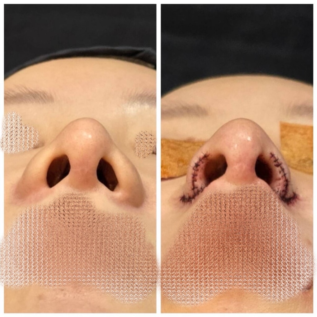 コーヘン美容外科鼻整形