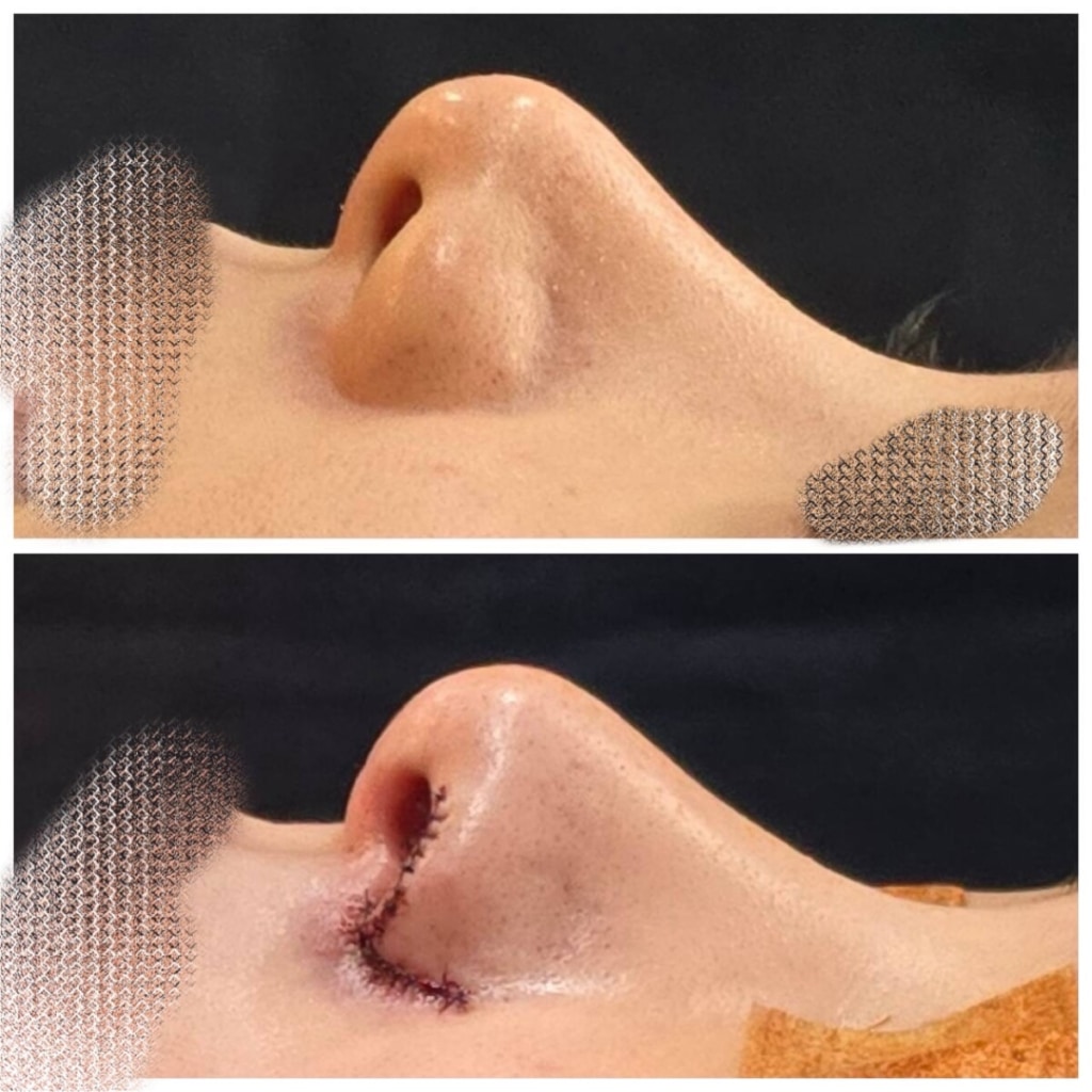 コーヘン美容外科の鼻整形