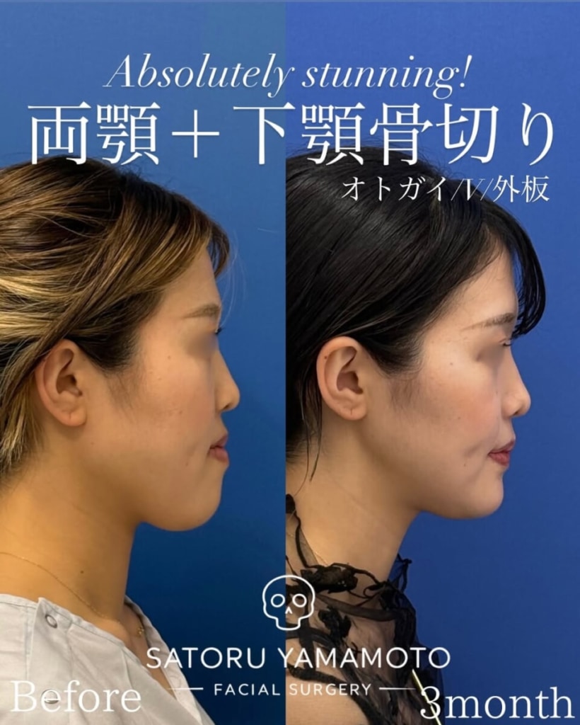 山本さとる先生の骨切り症例