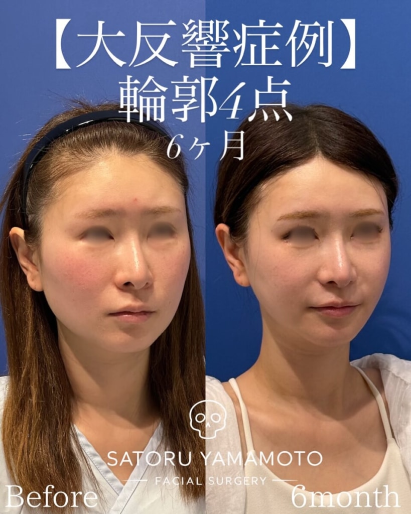 山本さとる先生の骨切り症例